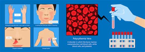 pv symptoms and signs.